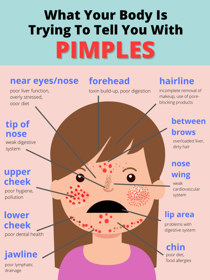 Acne And Health What Your Body Is Trying To Tell You With Pimples B 