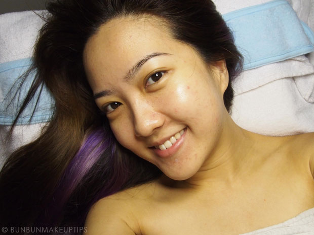 My-Skin-Ravaged-Allergic-Reaction-After-Facial-Experience_day-1-after-facial_1