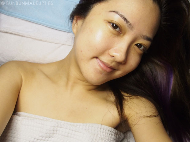 My-Skin-Ravaged-Allergic-Reaction-After-Facial-Experience_day-1-after-facial_2