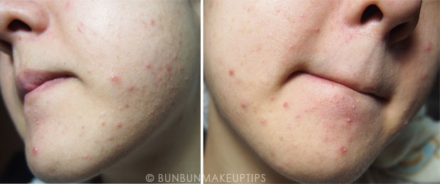 My-Skin-Ravaged-Allergic-Reaction-After-Facial-Experience_day-2-night-2.1
