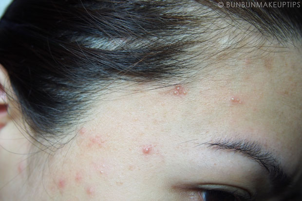 My-Skin-Ravaged-Allergic-Reaction-After-Facial-Experience_day-2-night-3