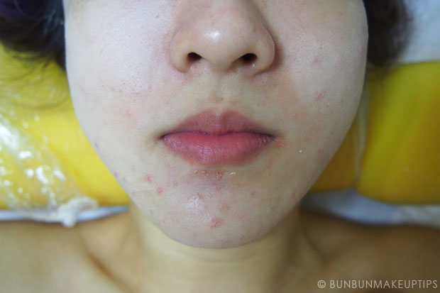 My-Skin-Ravaged-Allergic-Reaction-After-Facial-Experience_day-3-after-extraction-3