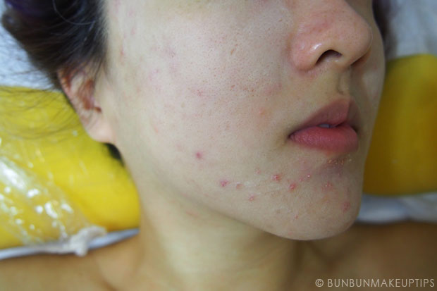 My-Skin-Ravaged-Allergic-Reaction-After-Facial-Experience_day-3-after-extraction-4