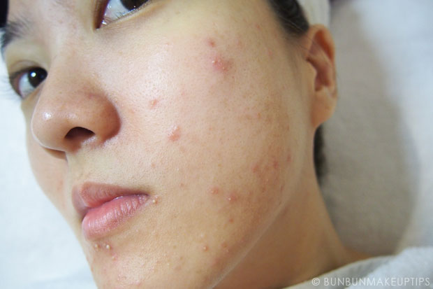 My-Skin-Ravaged-Allergic-Reaction-After-Facial-Experience_day-3-after-extraction_2