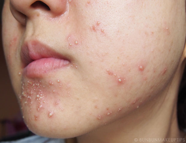 My-Skin-Ravaged-Allergic-Reaction-After-Facial-Experience_day-3-morning_2