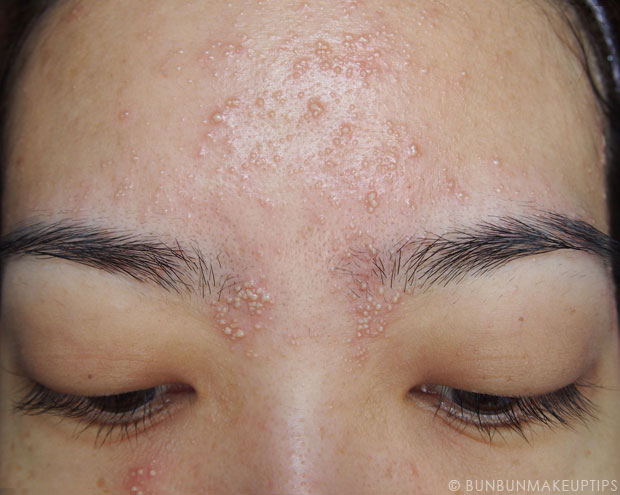 My-Skin-Ravaged-Allergic-Reaction-After-Facial-Experience_day-3-morning_4