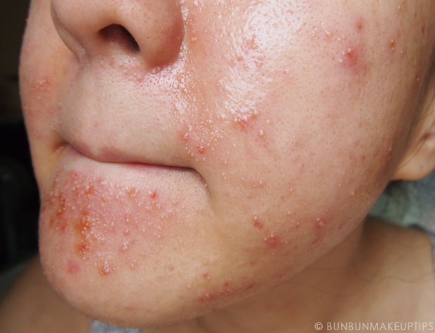 My-Skin-Ravaged-Allergic-Reaction-After-Facial-Experience_day-4-after-extraction-4