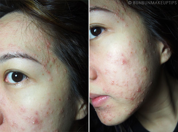 My-Skin-Ravaged-Allergic-Reaction-After-Facial-Experience_day-4-night_2