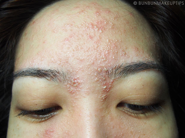 My-Skin-Ravaged-Allergic-Reaction-After-Facial-Experience_day-4-night_6