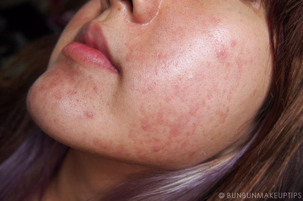 My-Skin-Ravaged-Allergic-Reaction-After-Facial-Experience_day-12