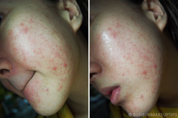 My-Skin-Ravaged-Allergic-Reaction-After-Facial-Experience_day-18