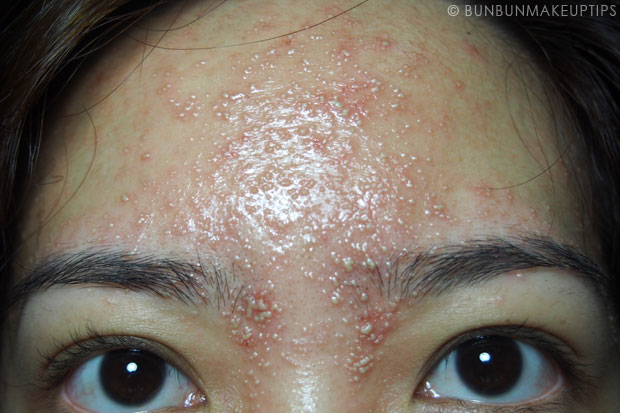 My-Skin-Ravaged-Allergic-Reaction-After-Facial-Experience_day-5-5am_3