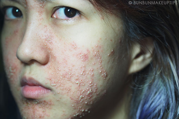 My-Skin-Ravaged-Allergic-Reaction-After-Facial-Experience_day-5-night_5
