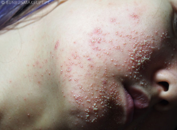 My-Skin-Ravaged-Allergic-Reaction-After-Facial-Experience_day-5-night_6