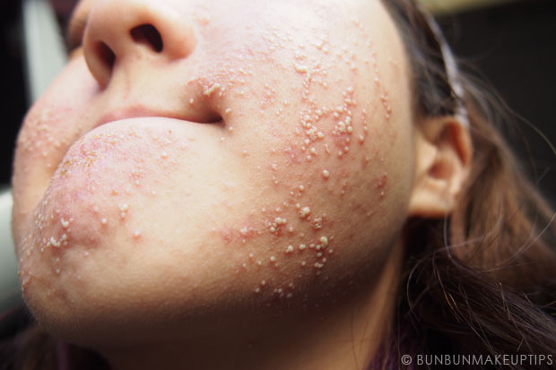 My-Skin-Ravaged-Allergic-Reaction-After-Facial-Experience_day-6-morning_2