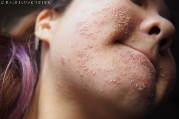 My-Skin-Ravaged-Allergic-Reaction-After-Facial-Experience_day-6-morning_3