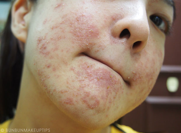 My-Skin-Ravaged-Allergic-Reaction-After-Facial-Experience_day-6-night_2