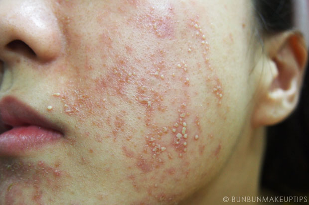 My-Skin-Ravaged-Allergic-Reaction-After-Facial-Experience_day-6-night_3
