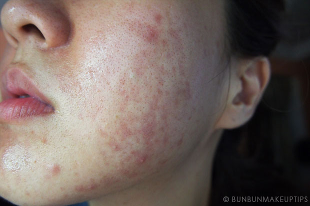 My-Skin-Ravaged-Allergic-Reaction-After-Facial-Experience_day-9