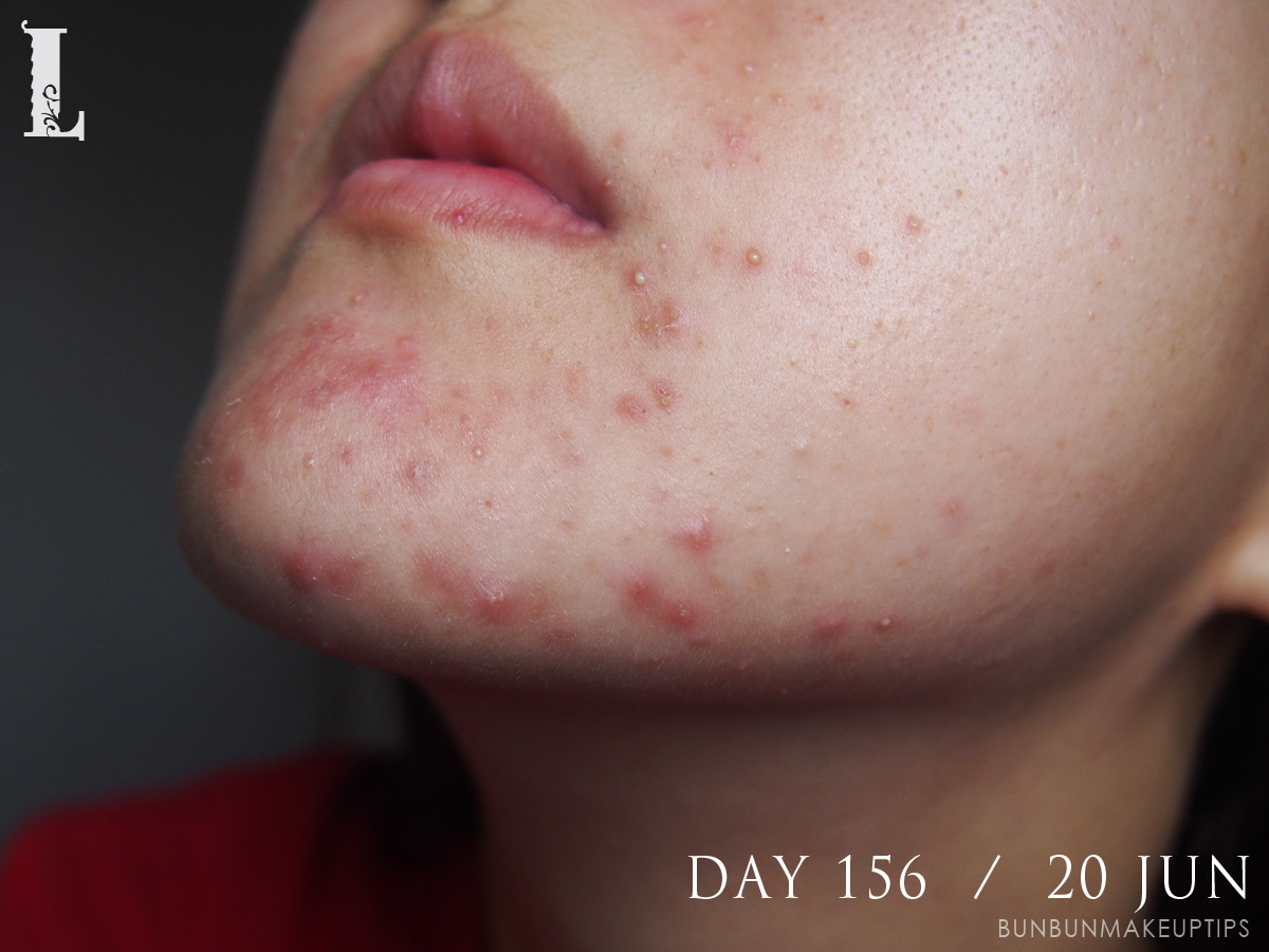 Acne-Treatment-Singapore-Day-156---20-Jun