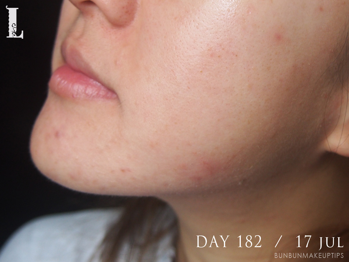 Acne-Treatment-Singapore-Day-182---17-Jul