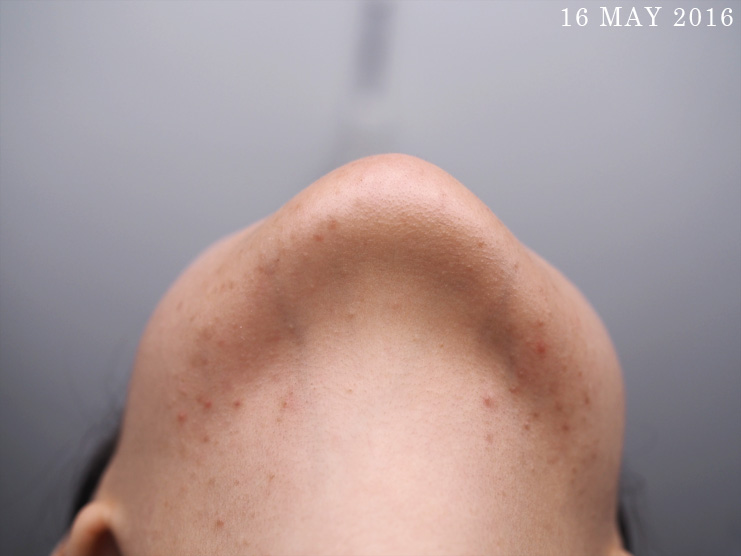 Skin-Life-Post-Facial_Part-2_[1605]16May