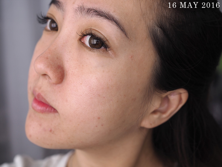 Skin-Life-Post-Facial_Part-2_[1605]16May_2