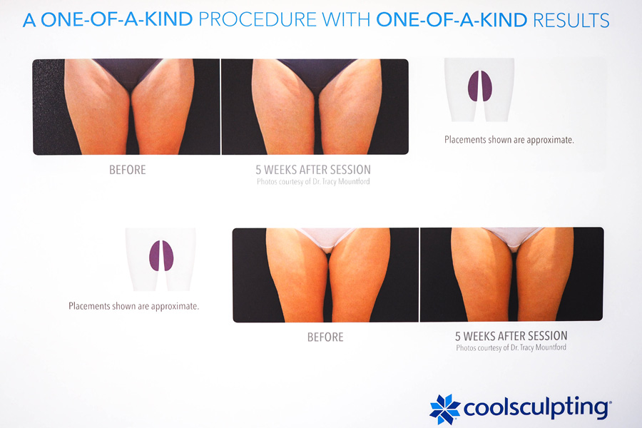 How-Slimming-CoolSculpting-Works_4