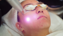 Tricks-For-Acne-Skin_2