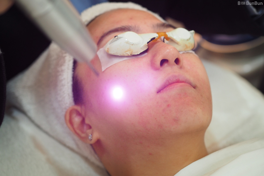 Tricks-For-Acne-Skin_2